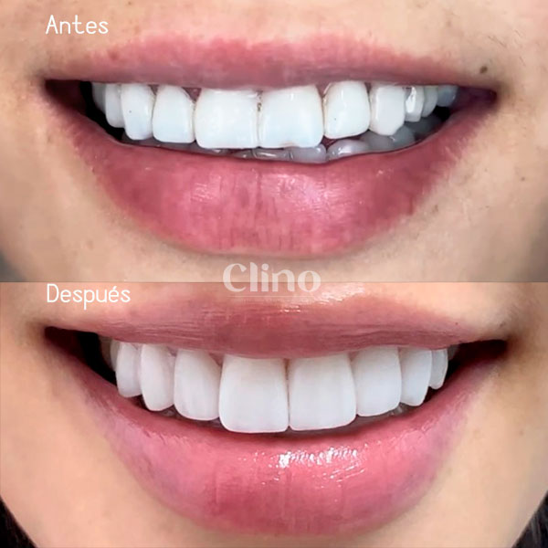 Antes y después carillas Emax CLINO Miraflores