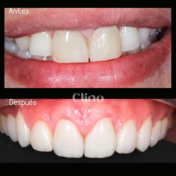 Antes y después diseño de sonrisa carillas Emax CLINO Miraflores