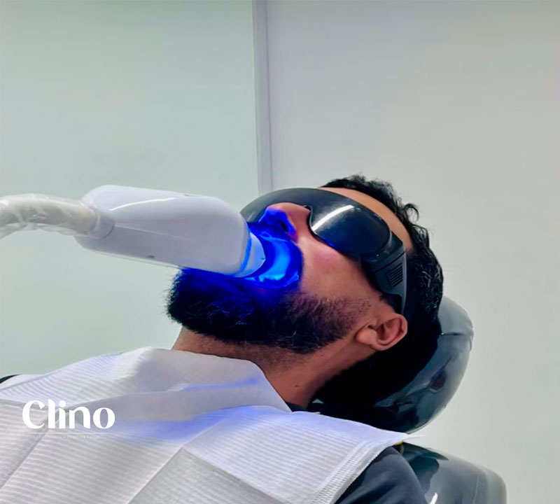 Blanqueamiento Dental Miraflores CLINO