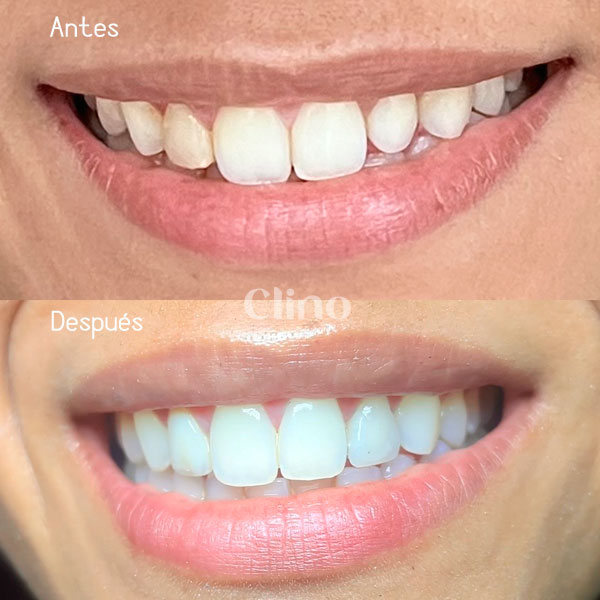 Antes y después carillas resina diseño de sonrisa CLINO Miraflores