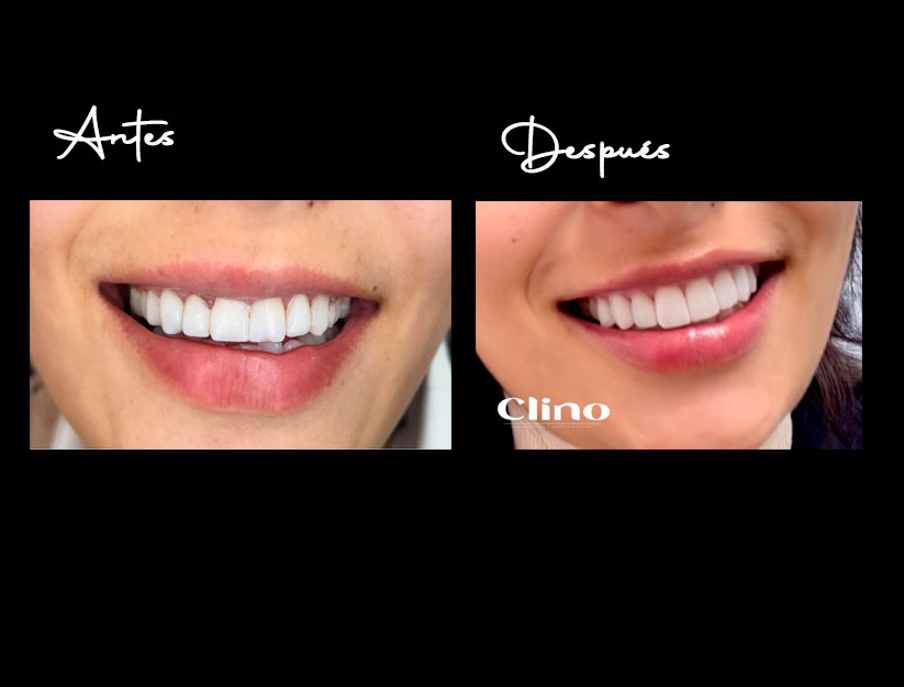 diseño de sonrisa con carillas emax Miraflores Lima CLINO resultado