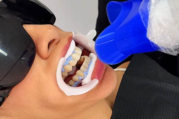 Blanqueamiento Dental · CLINO Miraflores