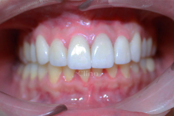 Carillas Dentales · CLINO Miraflores