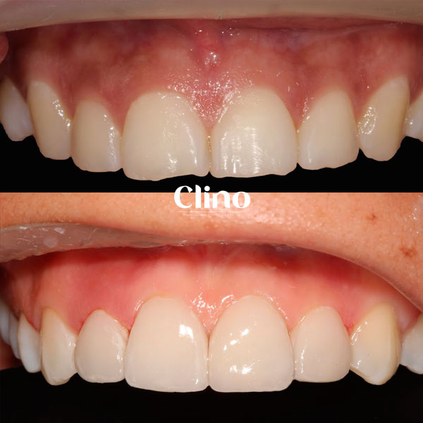 Antes y después diseño de sonrisa CLINO Miraflores