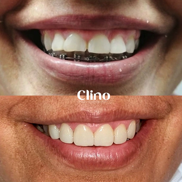 Antes y después carillas cerámica CLINO Miraflores