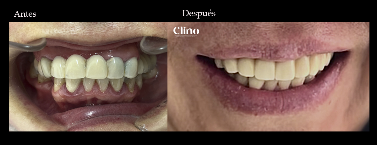 Antes y después de rehabilitación oral en Miraflores, CLINO